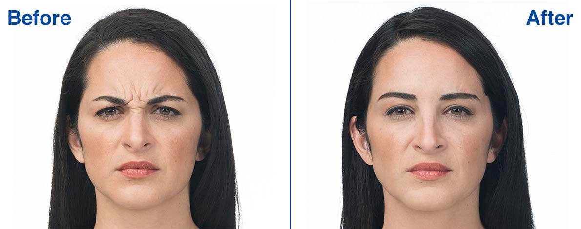 Botox Before and After Photo 3