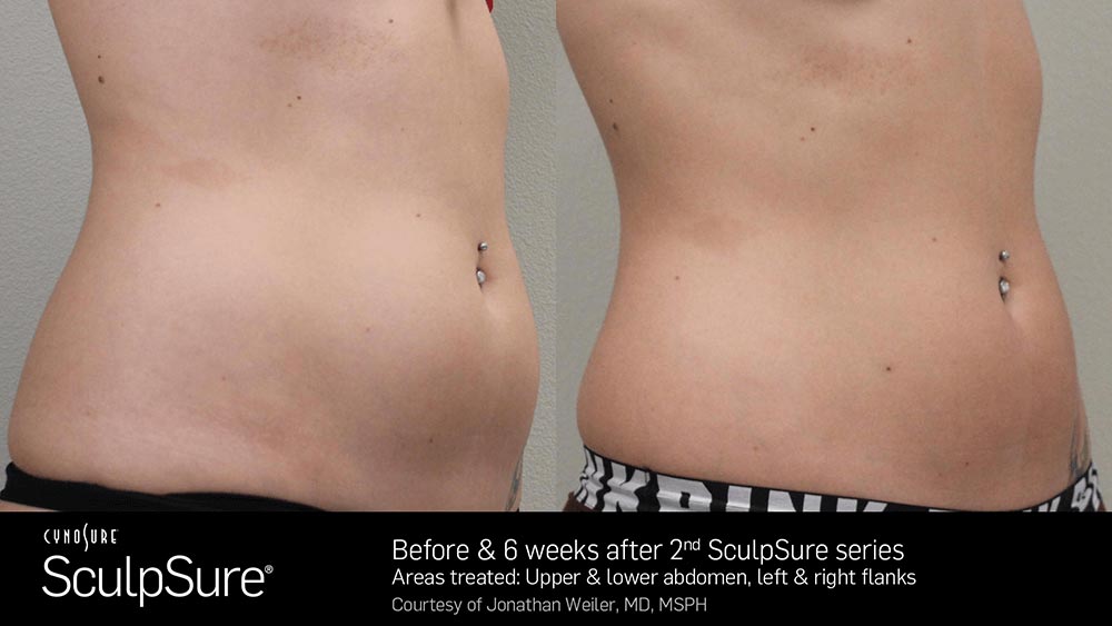 SculpSure Before and After Photo Abdomen Belly 10