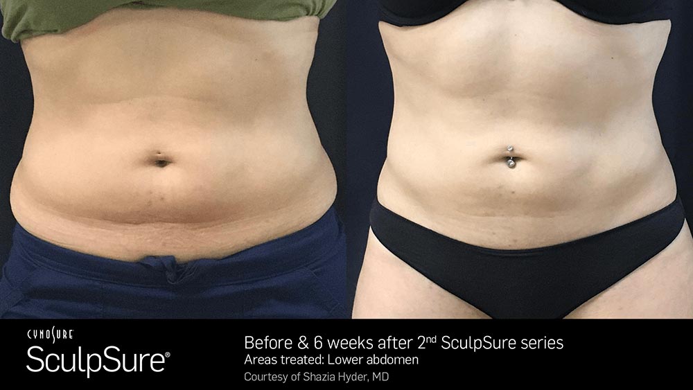 SculpSure Before and After Photo Abdomen Belly 7