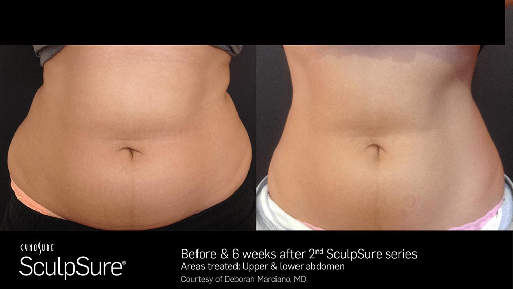 SculpSure Before and After Photo Abdomen Belly 8