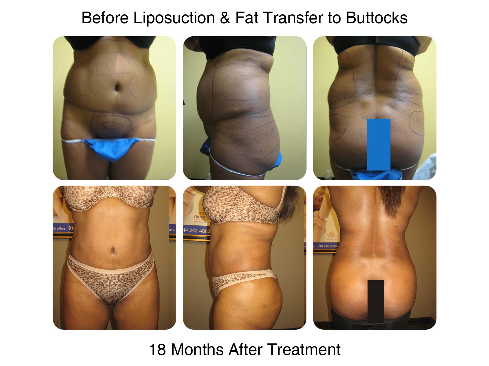Brazilian Butt Lift Fat Transfer Before and After 1