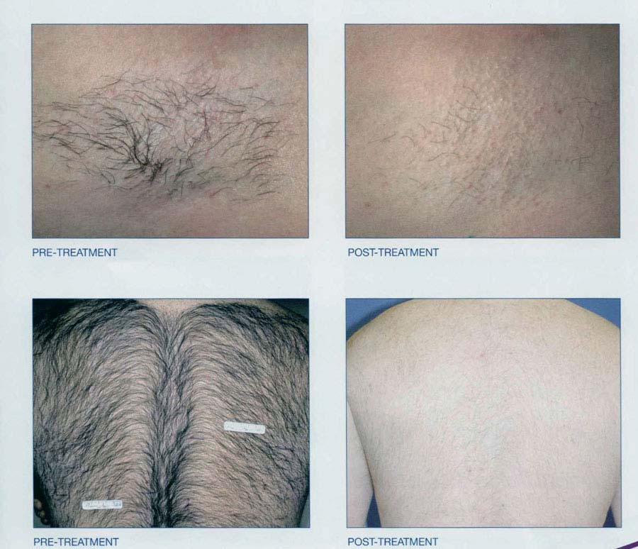 Laser Hair Removal - Permanently Remove Unwanted Hair