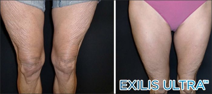 Crepey legs before and after New Radiance