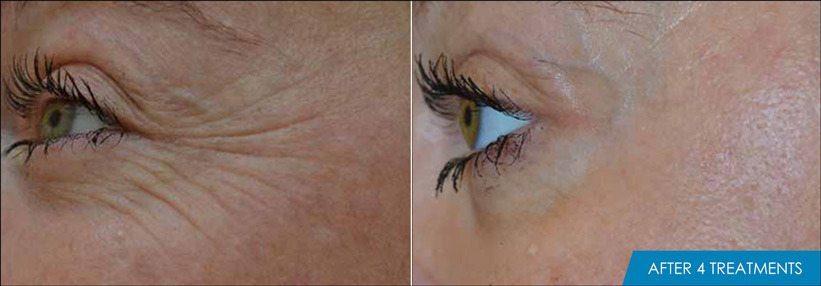 Exilis Ultra Eyes Before & After New Radiance