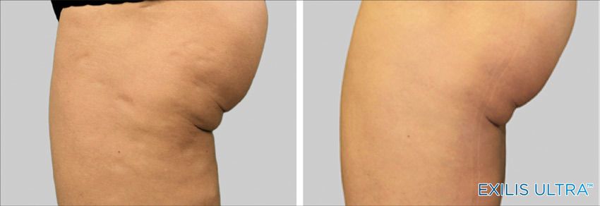 Exilis Leg Cellulite treatment before & After New Radiance