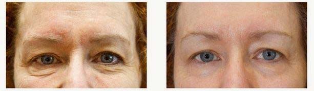 exilis ultra before & after eyes