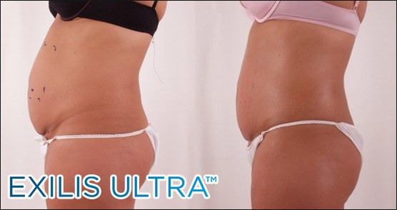 Female abdominal exilis before and after Radiance of Palm Beach