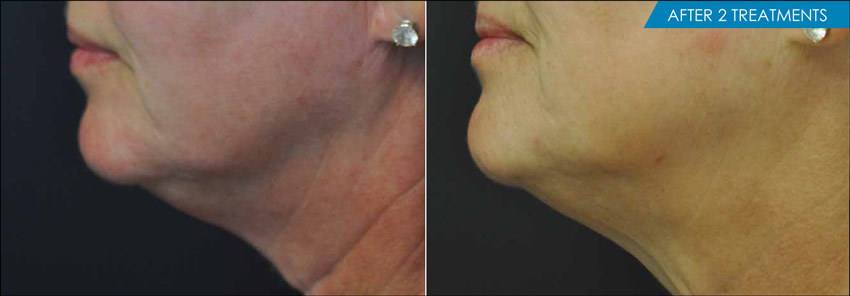 Exilis Neck before and after -2 treaments - New Radiance Cosmetic Center