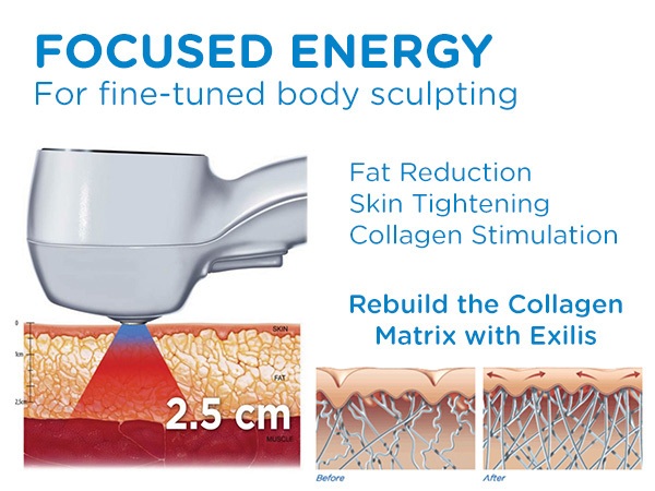 Exilis Skin tightening with Ultra Sculpting New Radiance Cosmetic Center