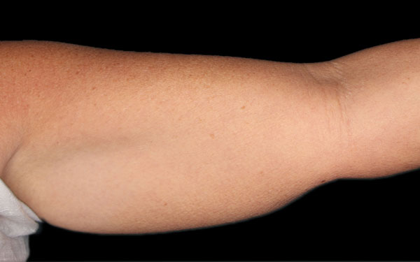 CoolSculpting Arms Treatment | Before