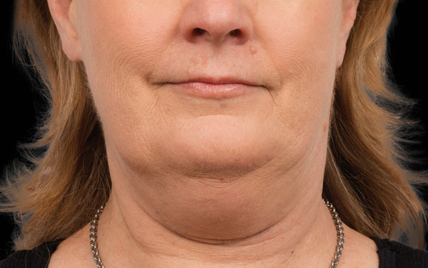 CoolSculpting Chin Treatment | Before