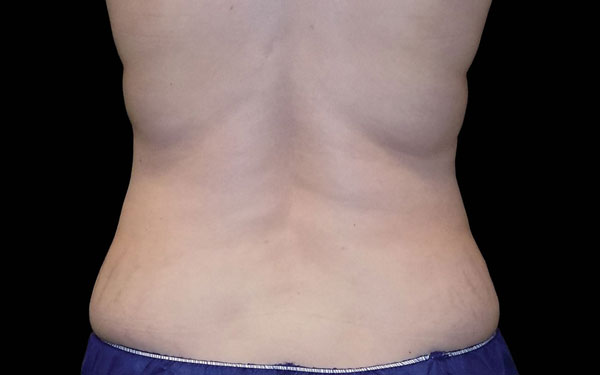 CoolSculpting Flanks Treatment and Love Handle Reduction | After