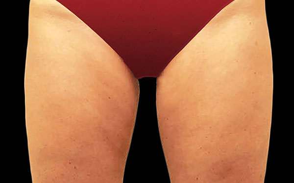 CoolSculpting Thighs Treatment | After