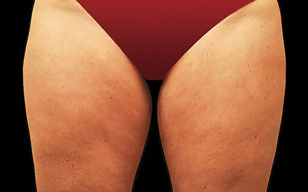 CoolSculpting Thighs Treatment | Before