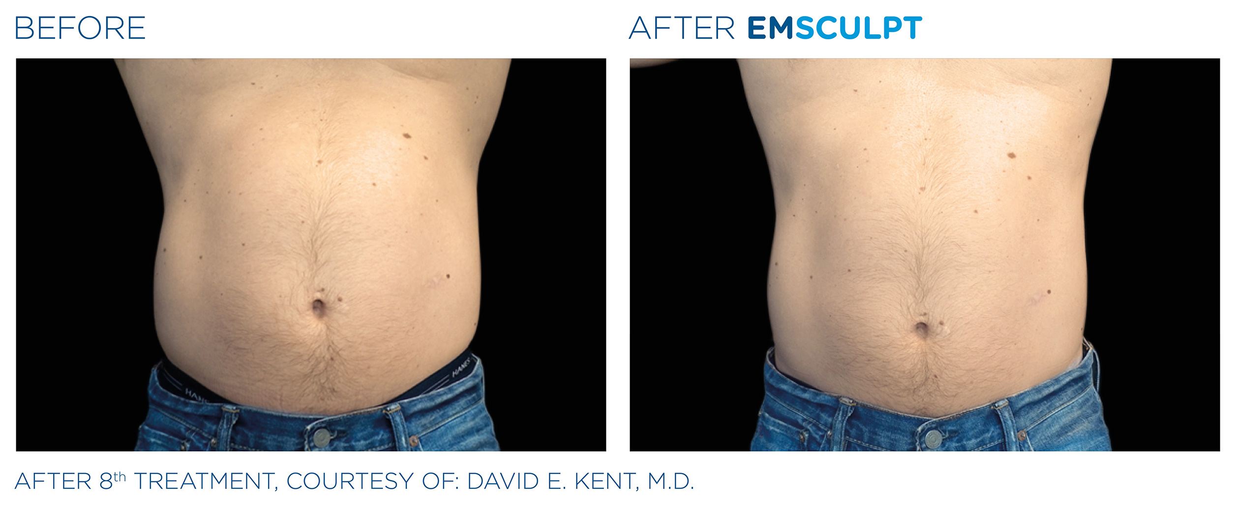 Emsculpt NEO for Abs & Abdomen Before & After