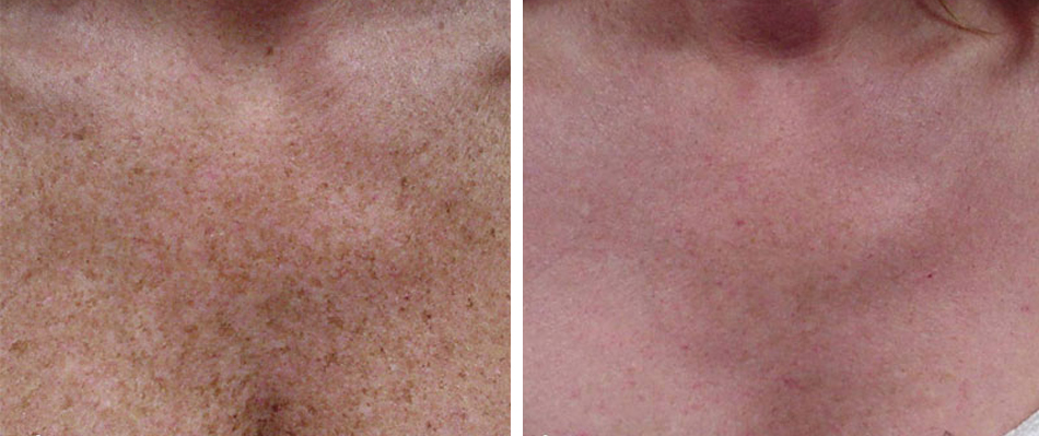 Fractional Co2 Laser Skin Resurfacing Takes Years Off Appearance