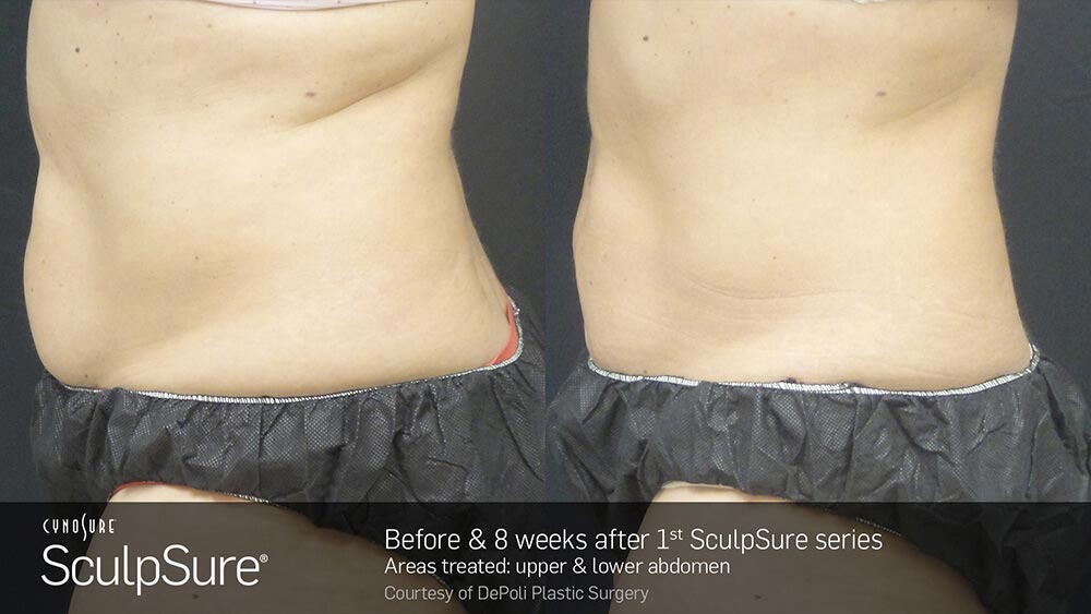 SculpSure Before and After Photo Abdomen Belly 1