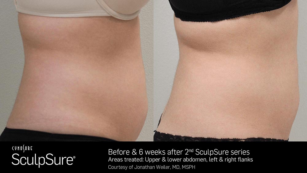 SculpSure Before and After Photo Abdomen Belly 11
