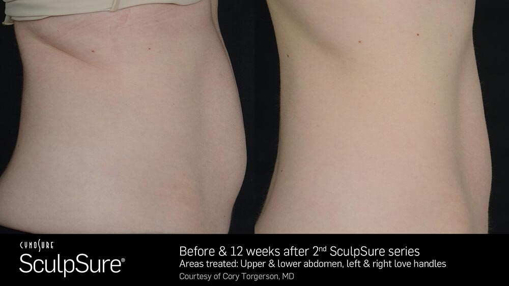 SculpSure Before and After Photo Abdomen Belly 12