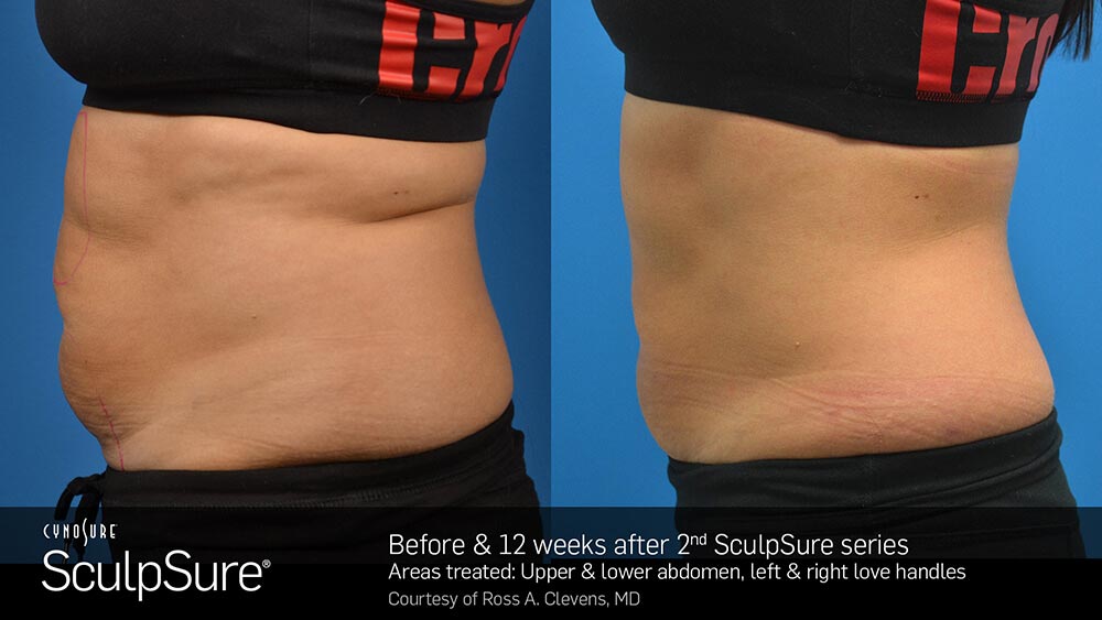 SculpSure Before and After Photo Abdomen Belly 13
