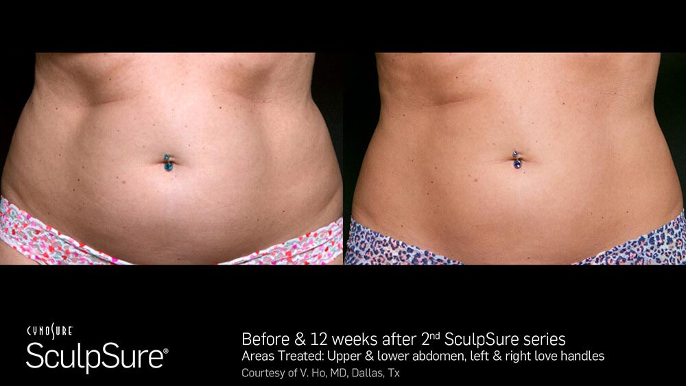 SculpSure Before and After Photo Abdomen Belly 14