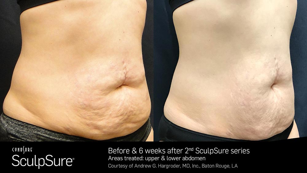 SculpSure Before and After Photo Abdomen Belly 15