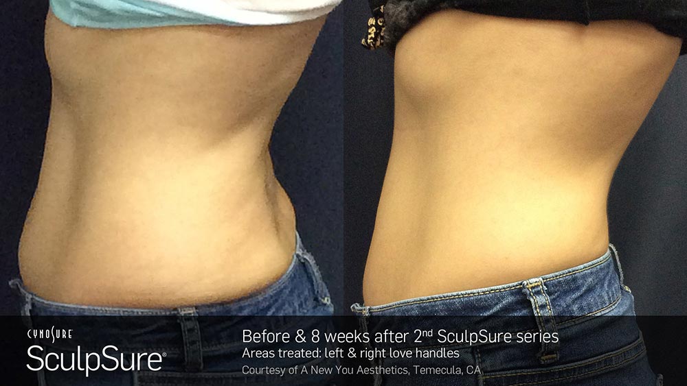 SculpSure Before and After Photo Abdomen Belly 16