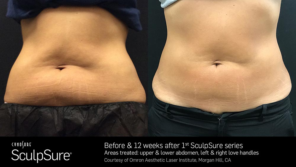 SculpSure Before and After Photo Abdomen Belly 17