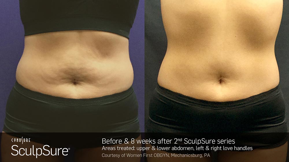 SculpSure Before and After Photo Abdomen Belly 18