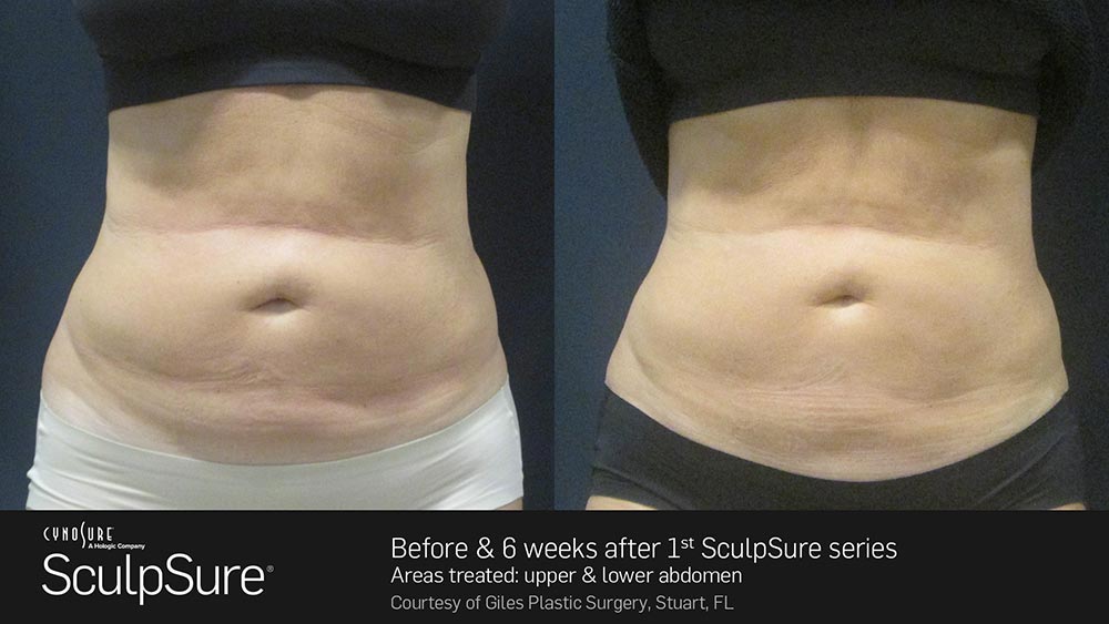 SculpSure Before and After Photo Abdomen Belly 19