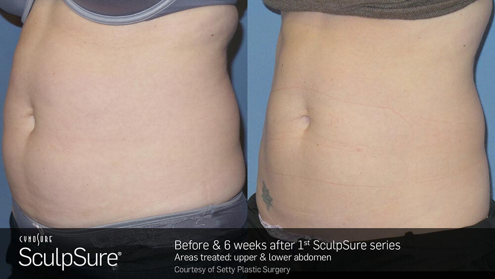 SculpSure Before and After Photo Abdomen Belly 2
