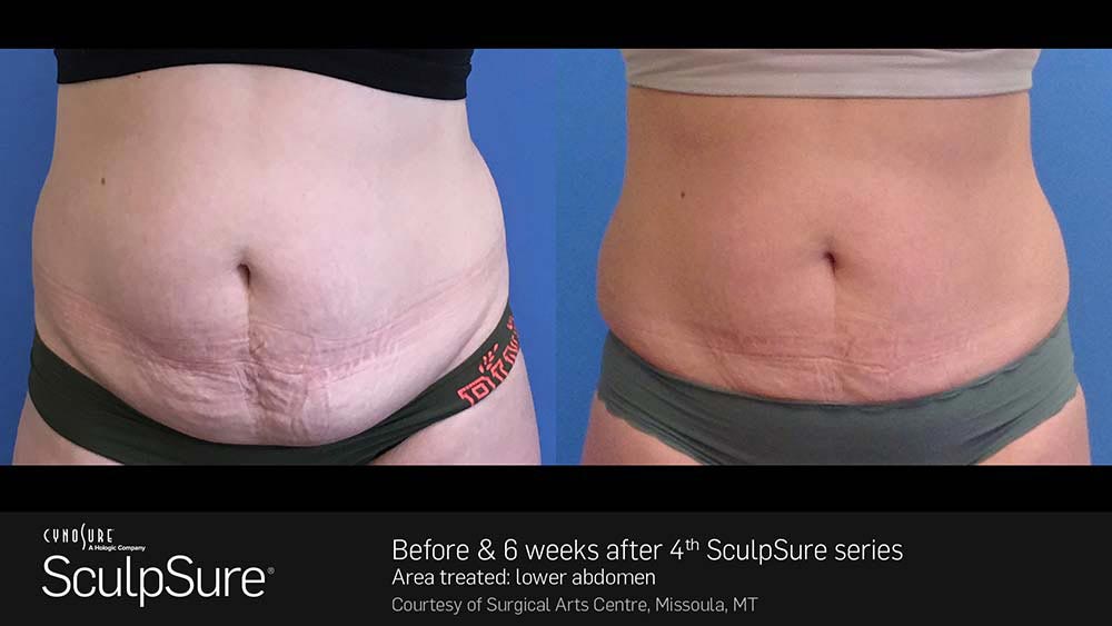 SculpSure Before and After Photo Abdomen Belly 20