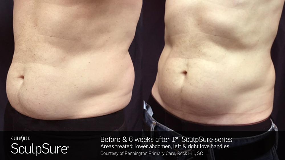 SculpSure Before and After Photo Abdomen Belly 21
