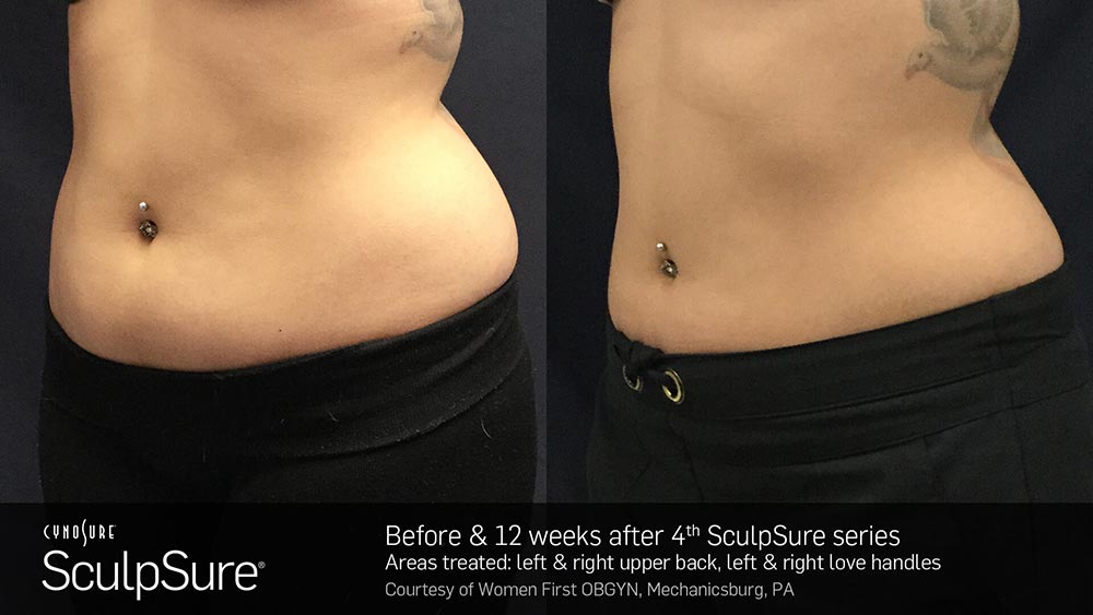 SculpSure Before and After Photo Abdomen Belly 22