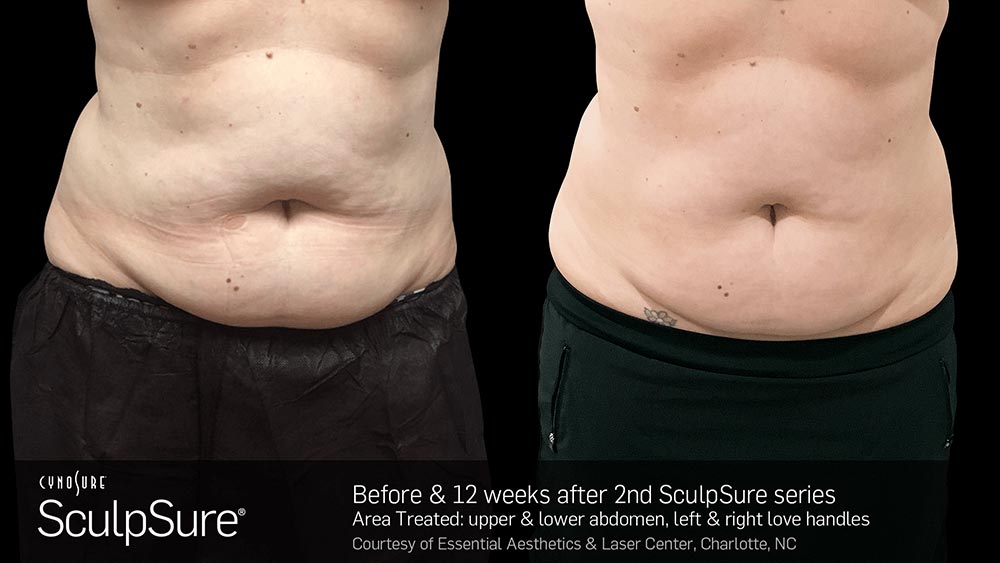 SculpSure Before and After Photo Abdomen Belly 3