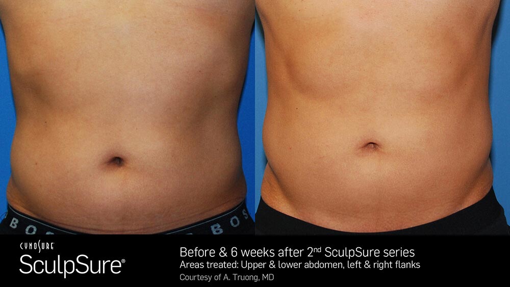 SculpSure Before and After Photo Abdomen Belly 4