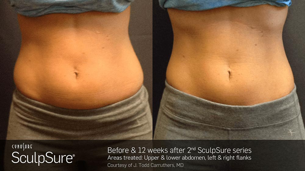 SculpSure Before and After Photo Abdomen Belly 5