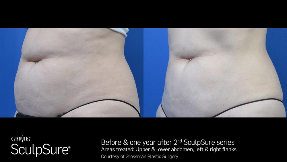SculpSure Before and After Photo Abdomen Belly 6