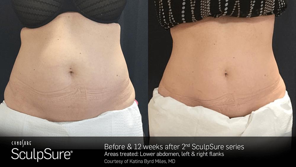 SculpSure Before and After Photo Abdomen Belly 9