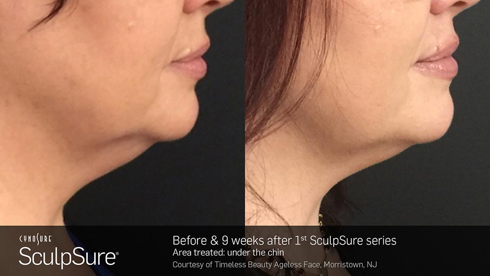 SculpSure Before and After Photo Chin 1