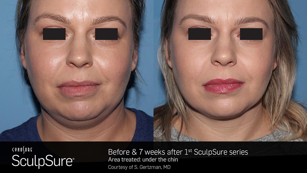 SculpSure Before and After Photo Chin 2