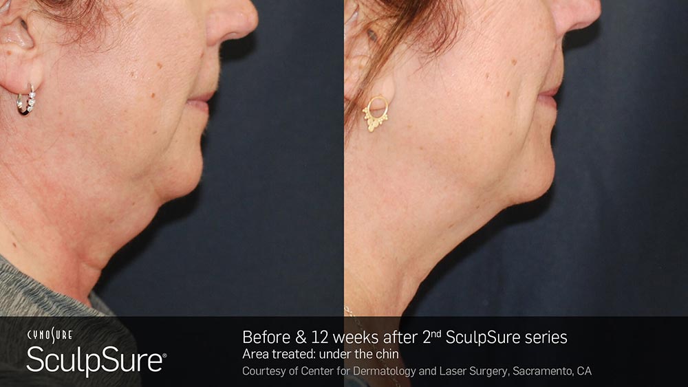 SculpSure Before and After Photo Chin 3