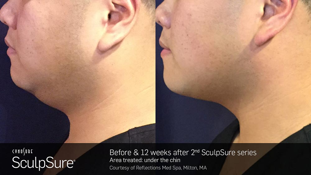 SculpSure Before and After Photo Chin 4