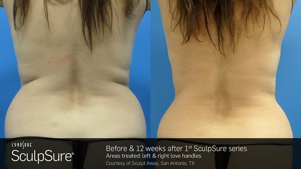 SculpSure Before and After Photo Love Handles 1