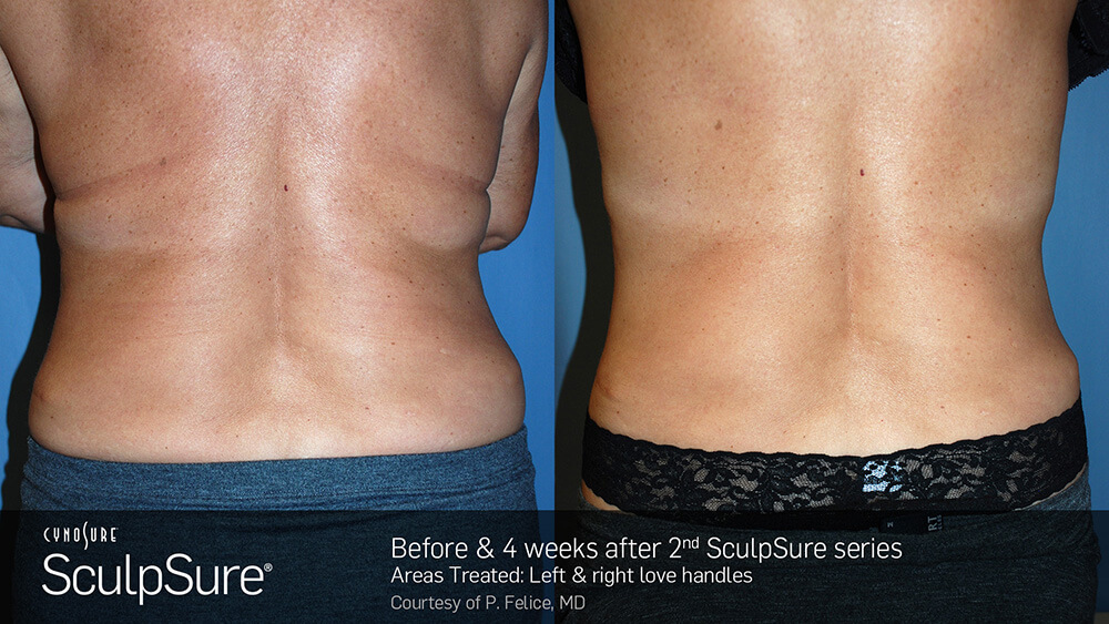 SculpSure Before and After Photo Love Handles 2