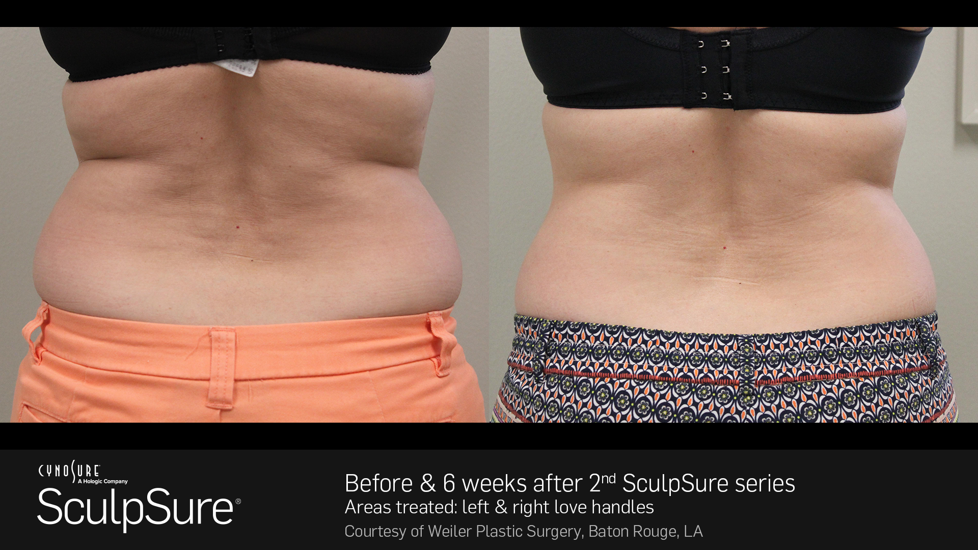 SculpSure Before and After Photo Love Handles 3