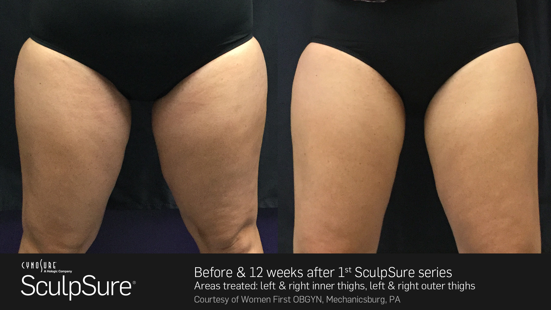 SculpSure Before and After Photo Thighs 1