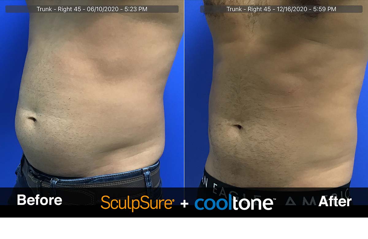 SculpSure + CoolTone Before & After