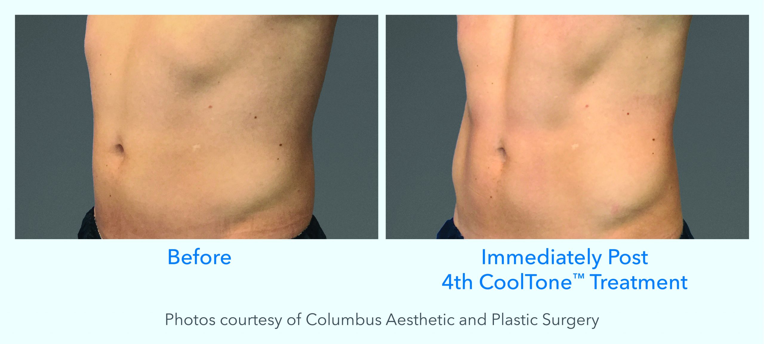 CoolTone Before and After Male Abdomen 1