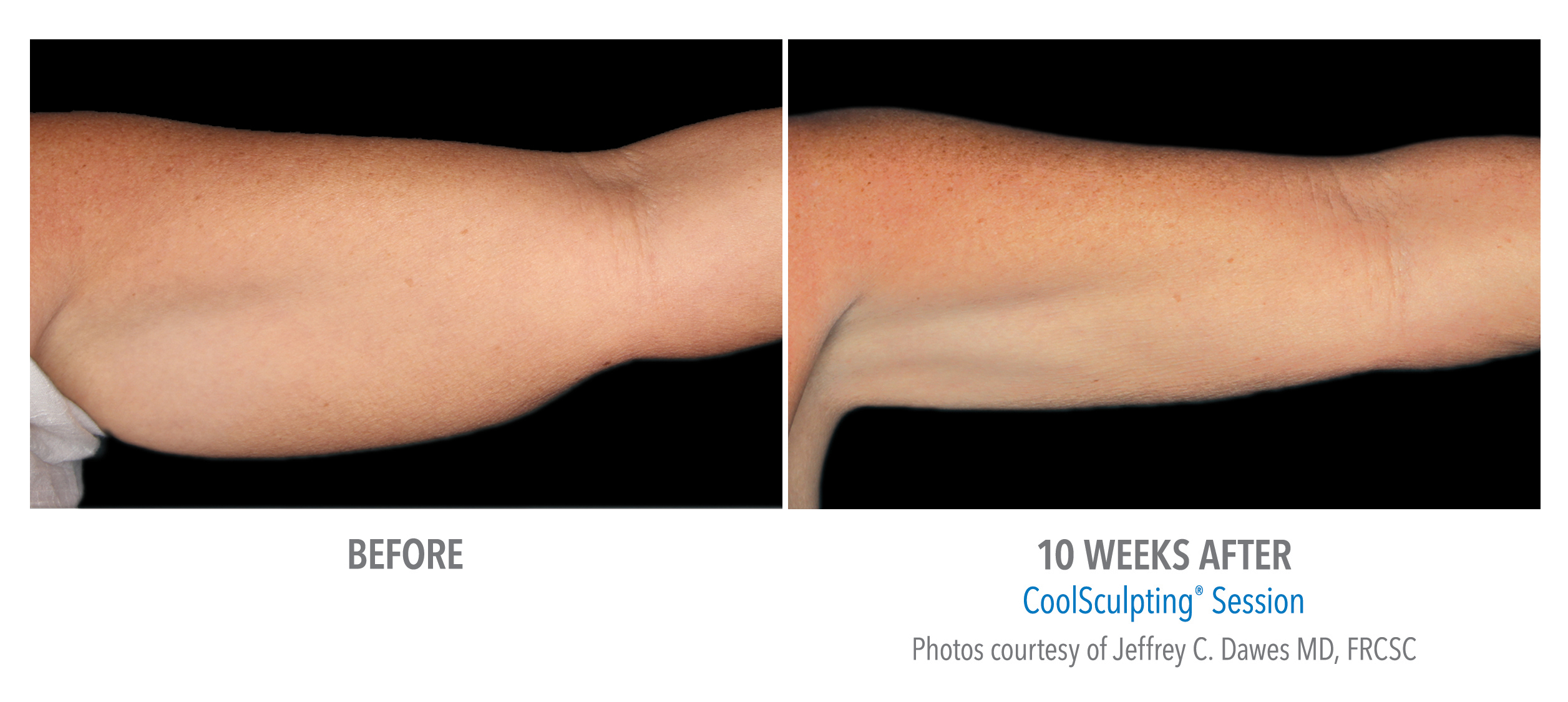 CoolSculpting Before & After Photos | Arms 1